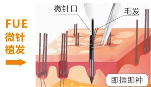微针植发