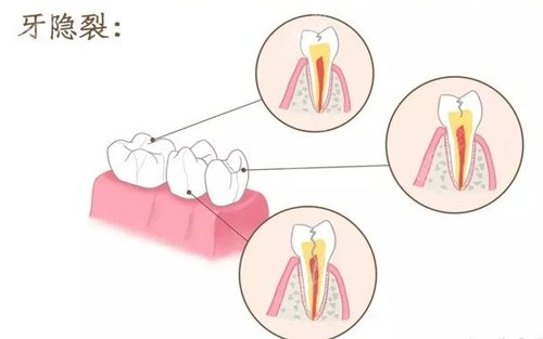 牙隐裂照片 牙隐裂照片