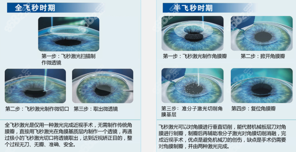 庞辰久做飞秒近视手术好