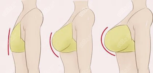 男性隆胸需要什么条件