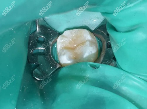 补牙治疗 补牙治疗