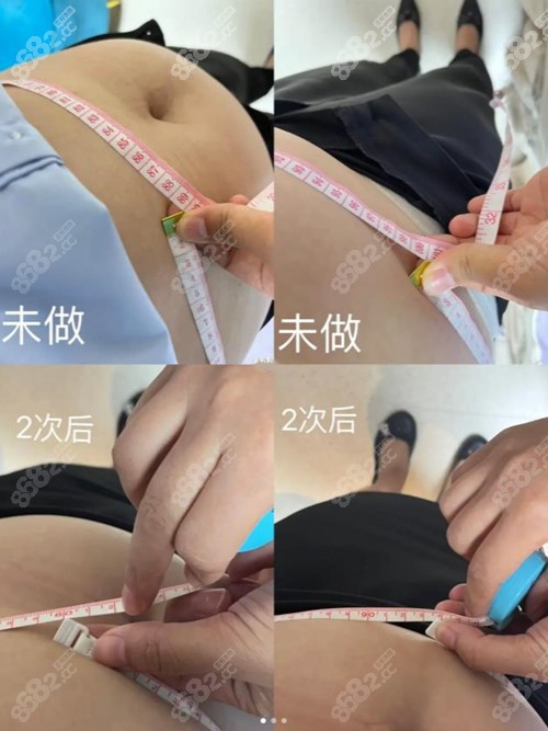 钻石超塑溶脂三次成效8682.cc