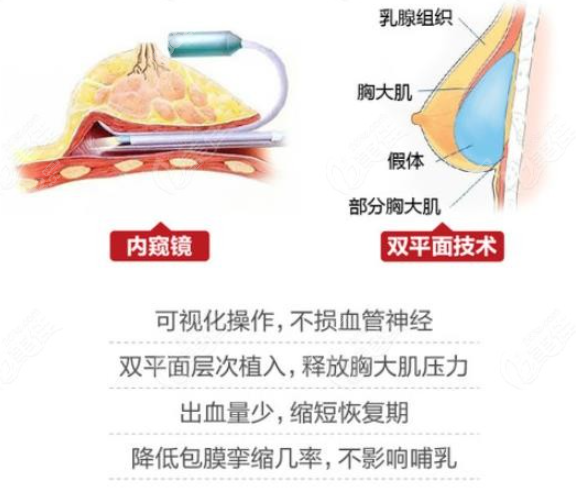 吴继东内窥镜双平面隆胸8682.cc