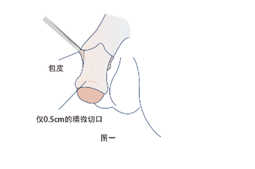 隐痕阴茎延长术图解一