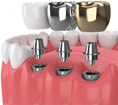 广元口腔医院收费标准,好评的牙科种牙正畸价格分享!