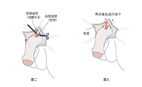 隐痕阴茎延长术图解二三