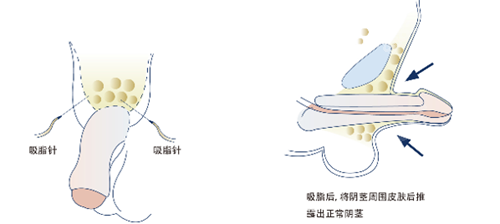 吸脂阴茎延长术