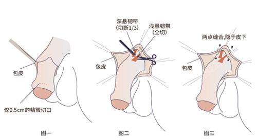 隐痕双延长术