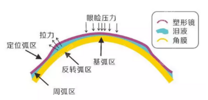 美国欧几里得角膜塑形镜