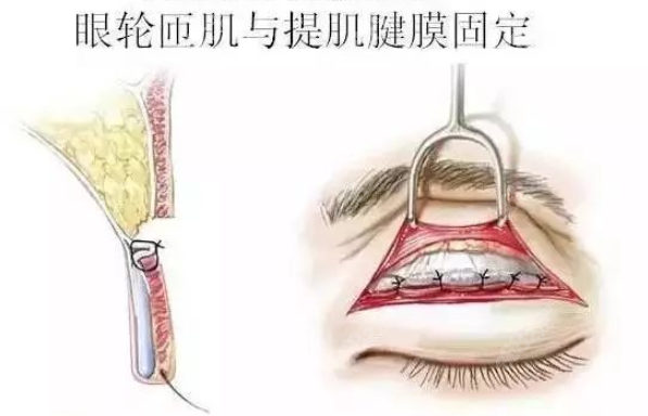 双眼皮手术图示