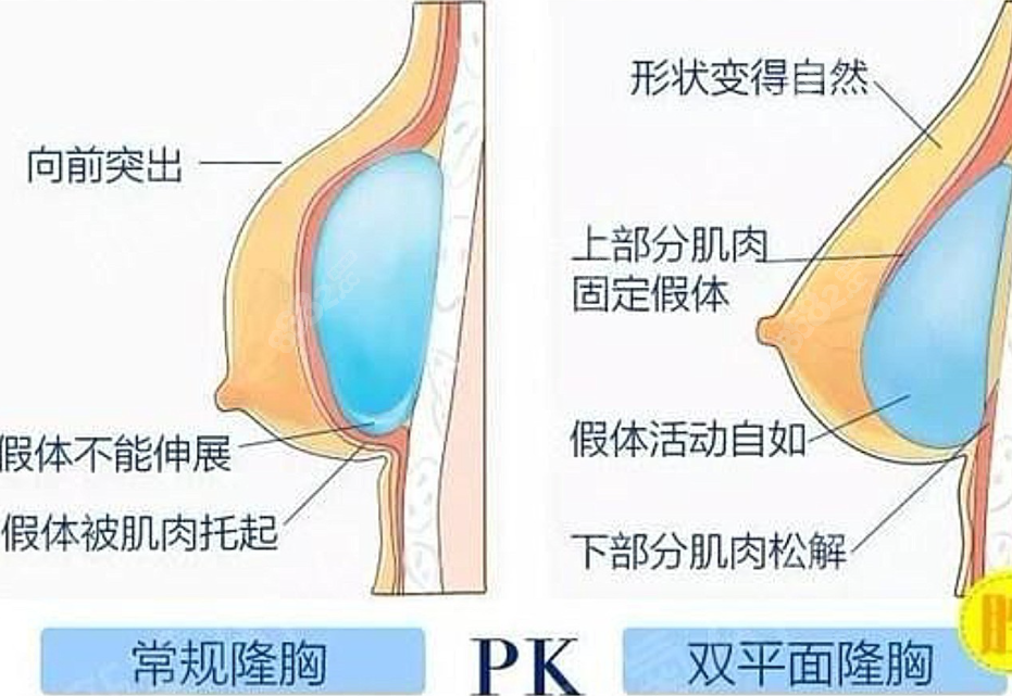 双平面隆胸8682.cc