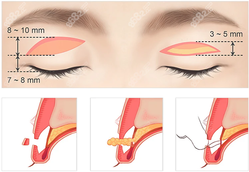 双眼皮解剖层次8682.cc