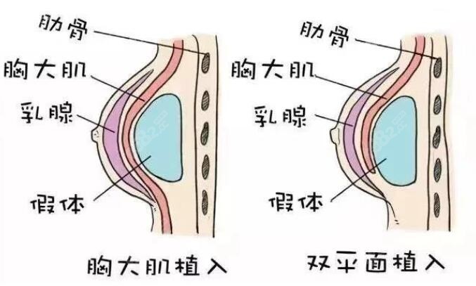 广州美恩医院隆胸好不好