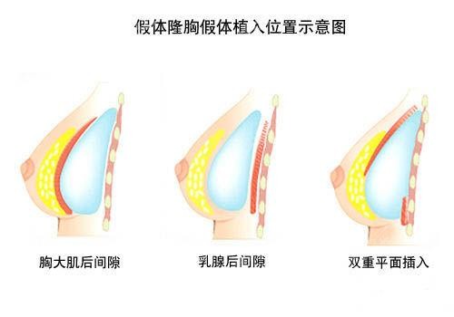 熊猛隆胸怎么样好看吗？