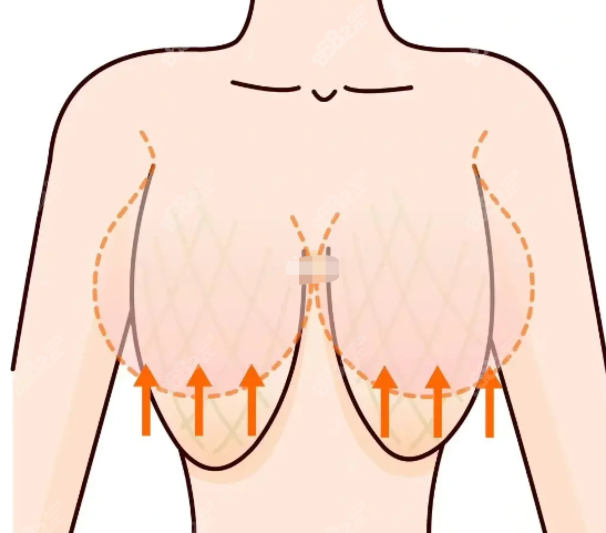 胸下垂可以通过手术解决吗