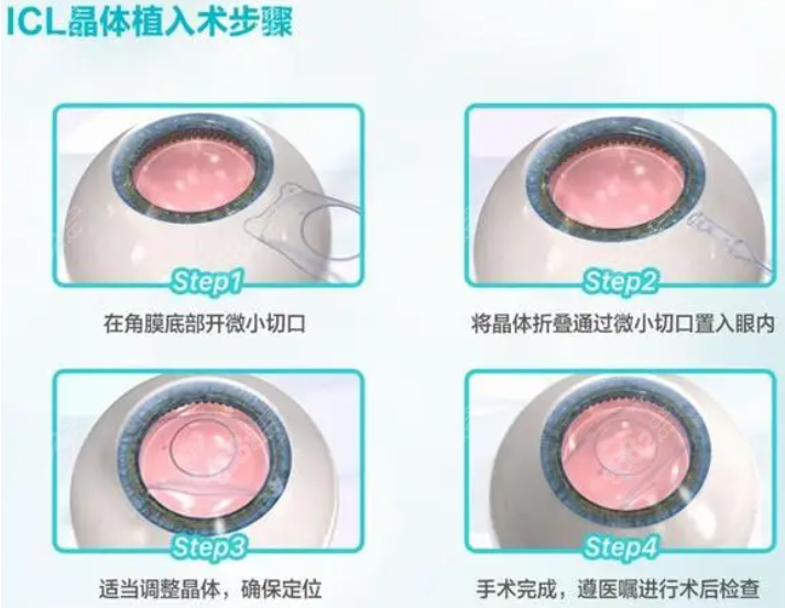 锦州何氏眼科医院icl晶体植入近视手术价格