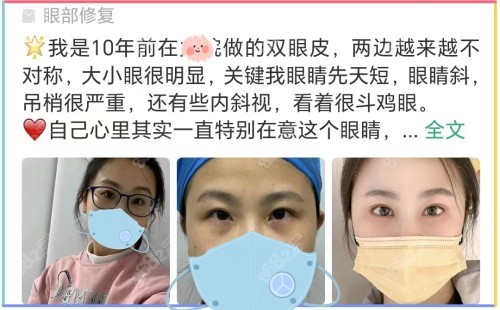 杜园园双眼皮修复技术怎么样