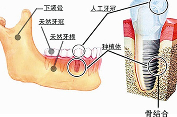 种植牙在牙骨内的图