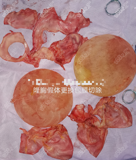 我的假体隆胸已经取出来了