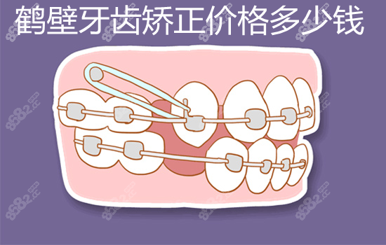 鹤壁牙齿矫正价格多少钱