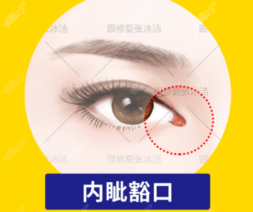 張冰潔修復(fù)眼角的術(shù)前情況