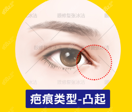 張冰潔修復(fù)眼角的癥狀