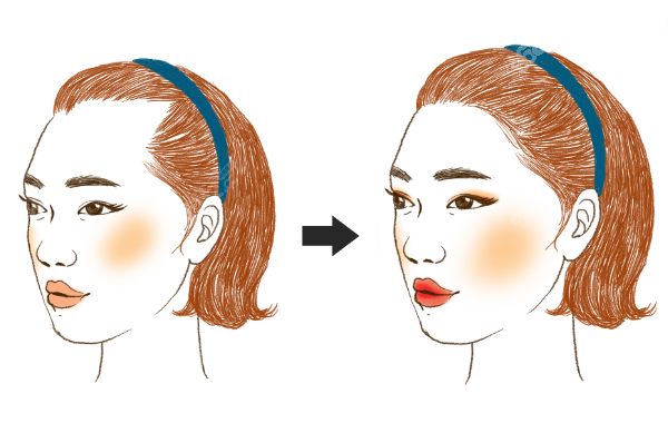 深圳富華醫(yī)療美容醫(yī)院做的植發(fā)