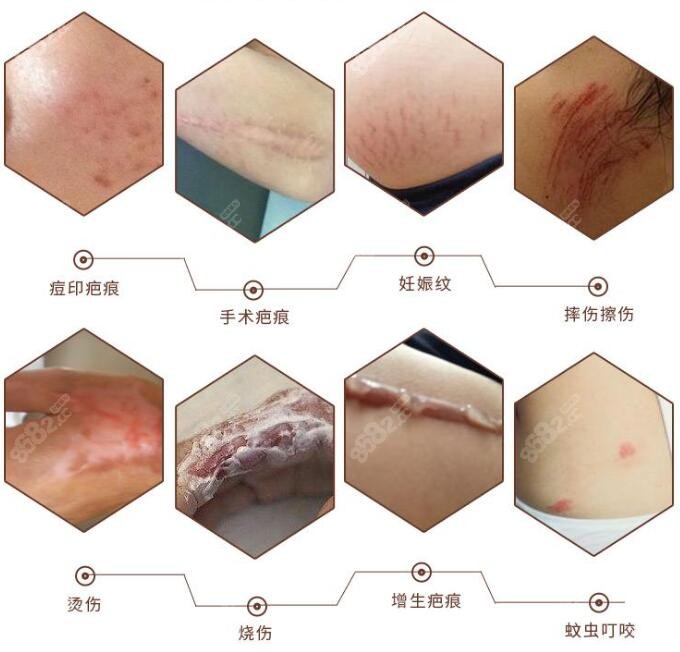 各种类型的疤痕