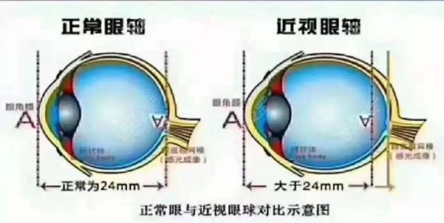 东莞眼科医院做近视矫正手术好的医院