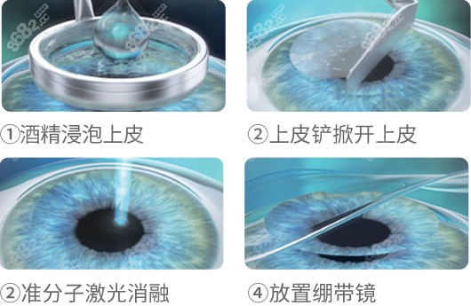 昆明华厦眼科医院准分子激光近视眼手术价格