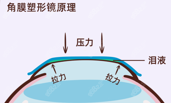 18岁以后还有必要戴角膜塑形镜吗？没必要