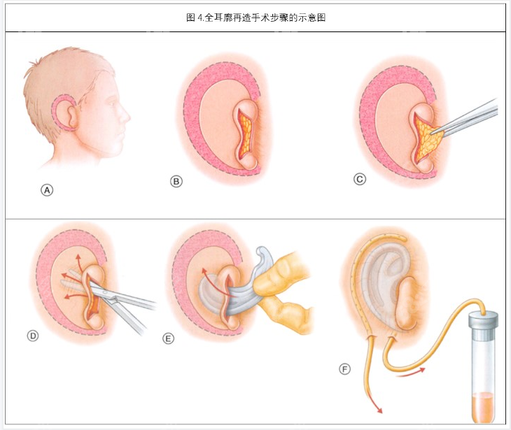 耳再造失败了怎么修复