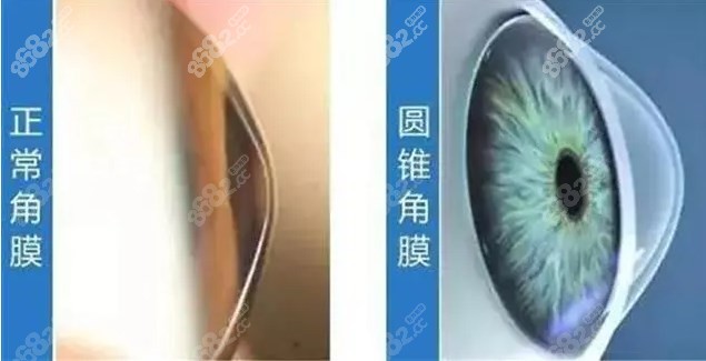 角膜内皮移植术