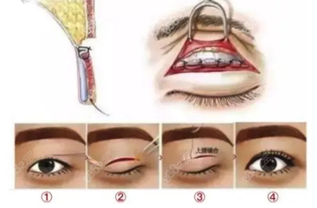 张芳医生做双眼皮用的纳米血管保留术