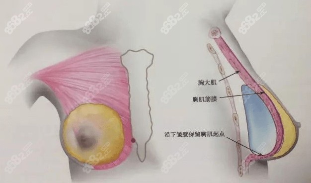 吴江山隆胸技术怎么样？