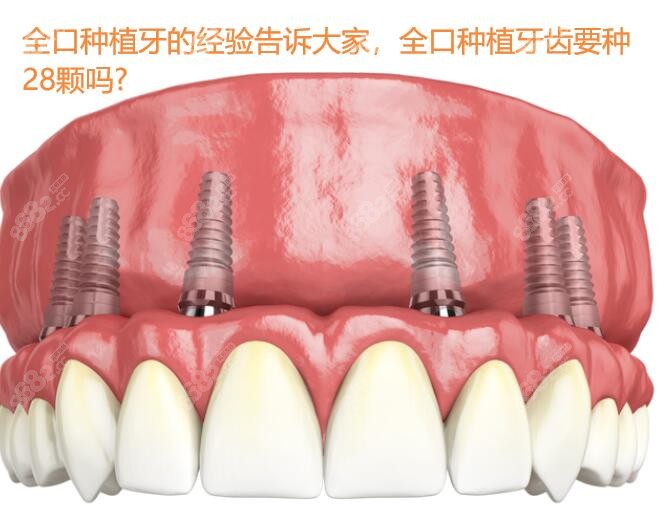 全口种植牙的经验告诉大家，全口种植牙齿要种28颗吗?
