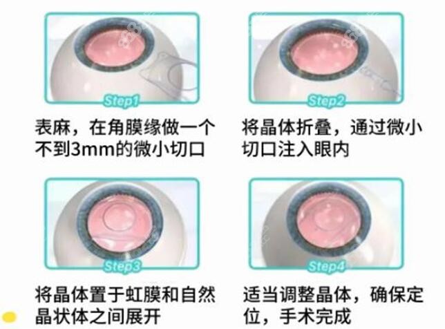 郑州刘保松和<!--<i data=20240705-sp></i>-->医生做晶体植入的原理www.8682.cc