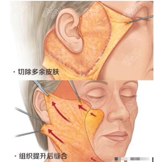 北京杨大平拉皮手术范例