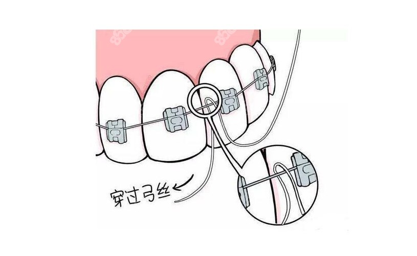 金属矫正