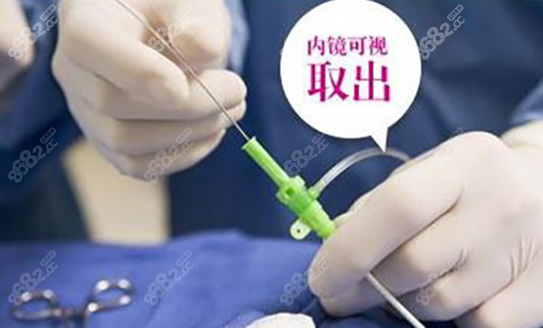 奥美定取出