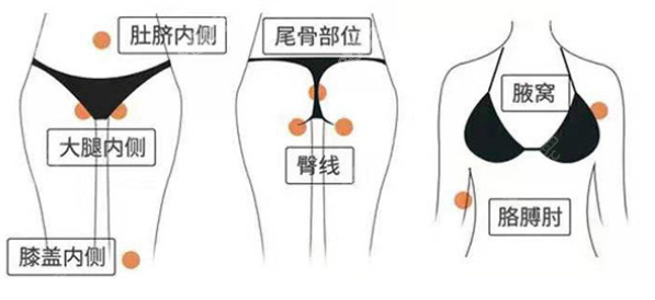 广州美莱张毓吸脂切口隐蔽