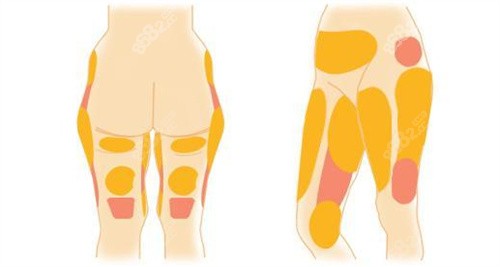 脂肪分布图 脂肪分布图