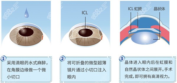 什么是EVOICL人工晶体植入8682.cc