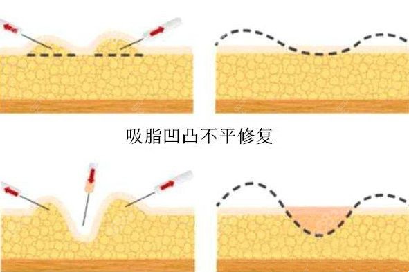 吸脂凹凸不平疤痕、色素沉淀怎么消除