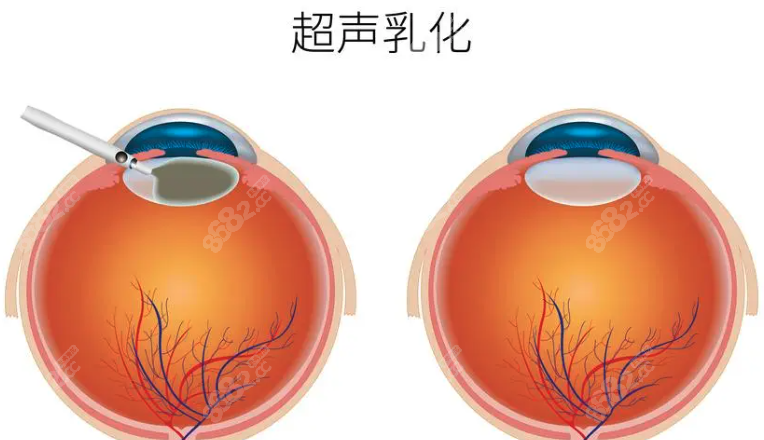 白内障晶体植入可以二次更换吗