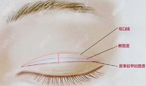 上海杜园园修复双眼皮怎么样