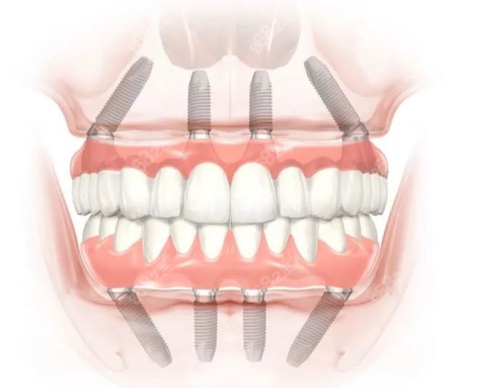 满口8颗种植体集采费用