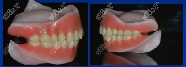 石家庄吸附性义齿价格表-老年人做全口吸附性假牙要2-4万起