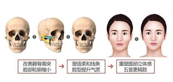 颧骨内推手术过程图