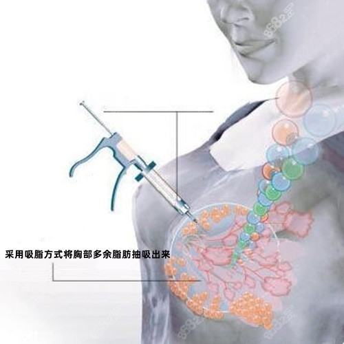 太原缩胸手术有名医院做吸脂缩胸的手术原理www.8682.cc